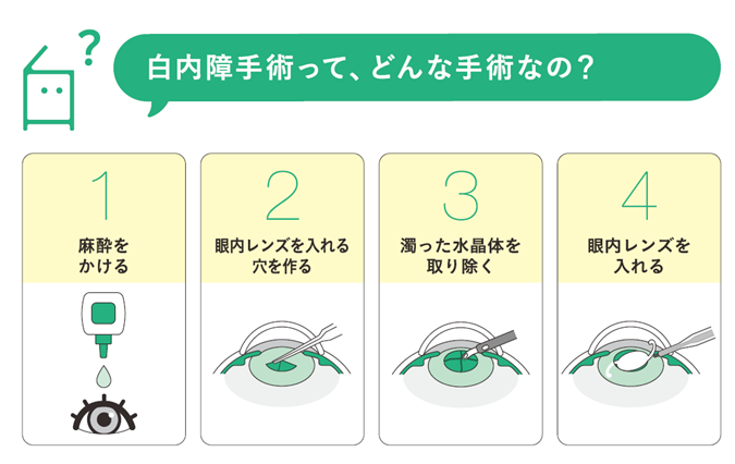 白内障手術って、どんな手術なの？