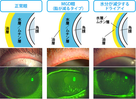 涙の状態による涙の層及び眼の状態比較